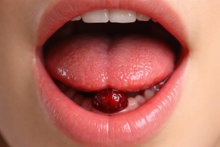 découvrez les symptômes d'une boule de sang sous la langue et quand consulter un professionnel de santé pour ne pas ignorer ce signe important.