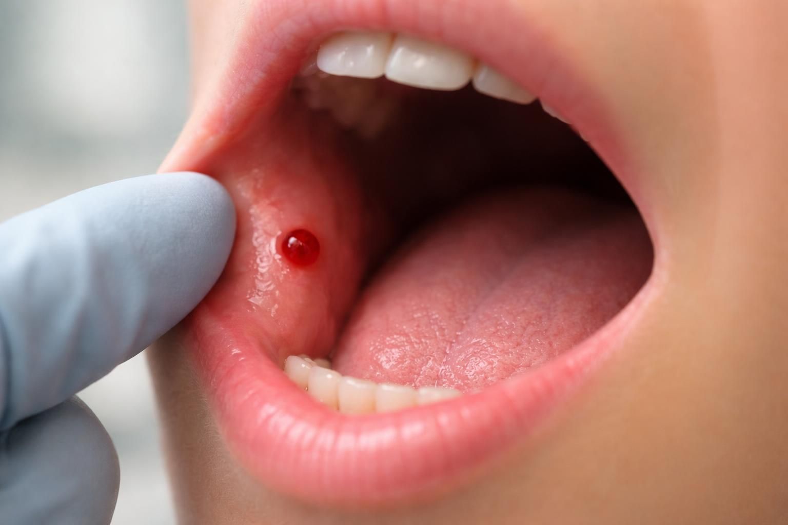 découvrez les causes possibles, les risques et les conseils pour gérer une petite boule de sang dans la bouche afin de préserver votre santé bucco-dentaire.