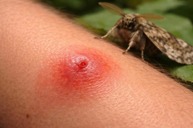 découvrez tout ce que vous devez savoir sur la piqûre du papillon de nuit, ses dangers potentiels et les précautions à prendre pour vous protéger efficacement.